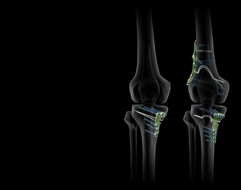 Radiographie de genoux avec implants